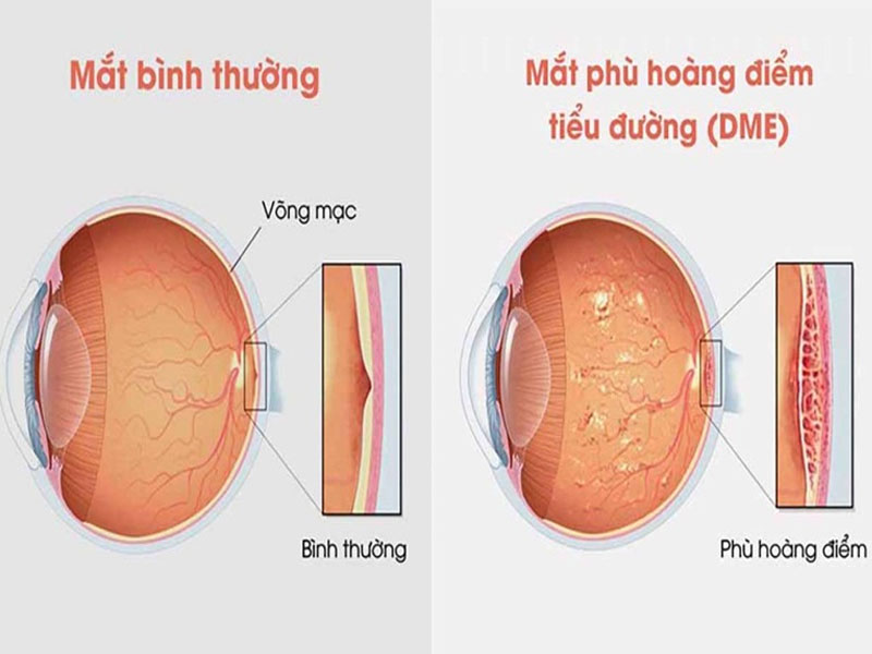 Dấu hiệu của bệnh thường đến từ sự bất thường của mắt, như dễ nhòe, nhìn thấy điểm đen
