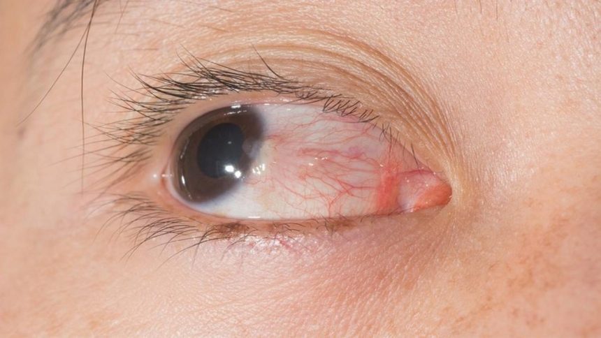 Đau hốc mắt là gì ? Có phải là dấu hiệu của bệnh nguy hiểm ?