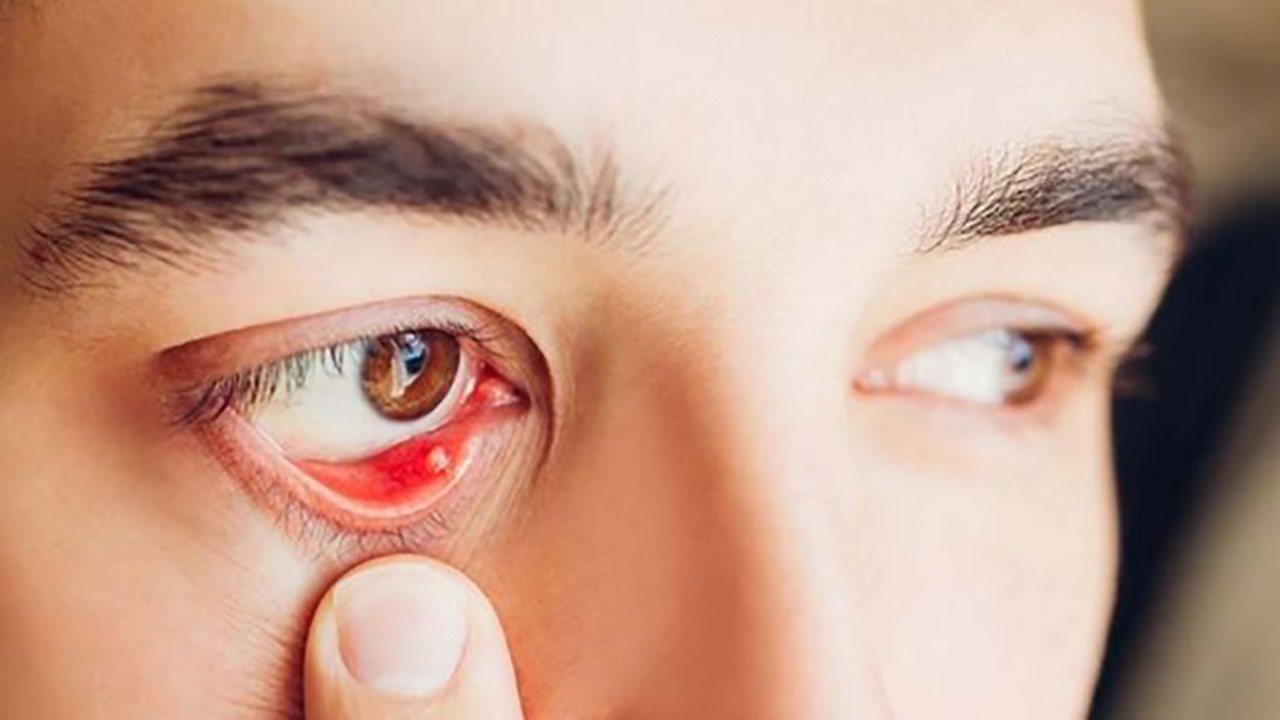 Bệnh đau mắt hột là gì? 