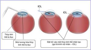 Bệnh đục thủy tinh thể