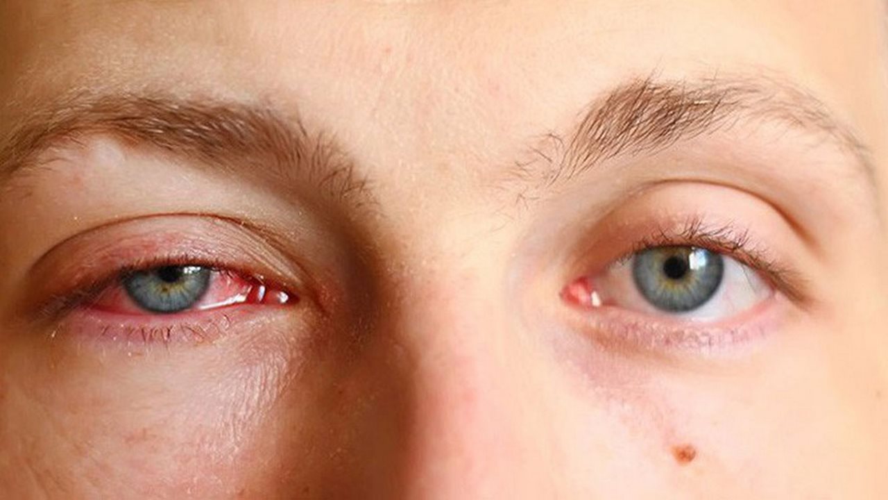 Định nghĩa cơ bản của bệnh đau mắt đỏ là gì?