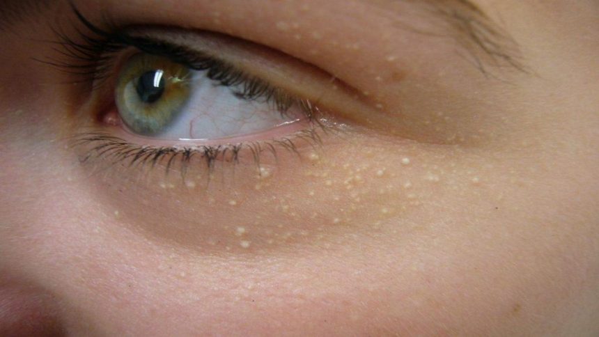 Mụn cơm ở mắt là gì? Dấu hiệu nhận biết,cách phòng ngừa